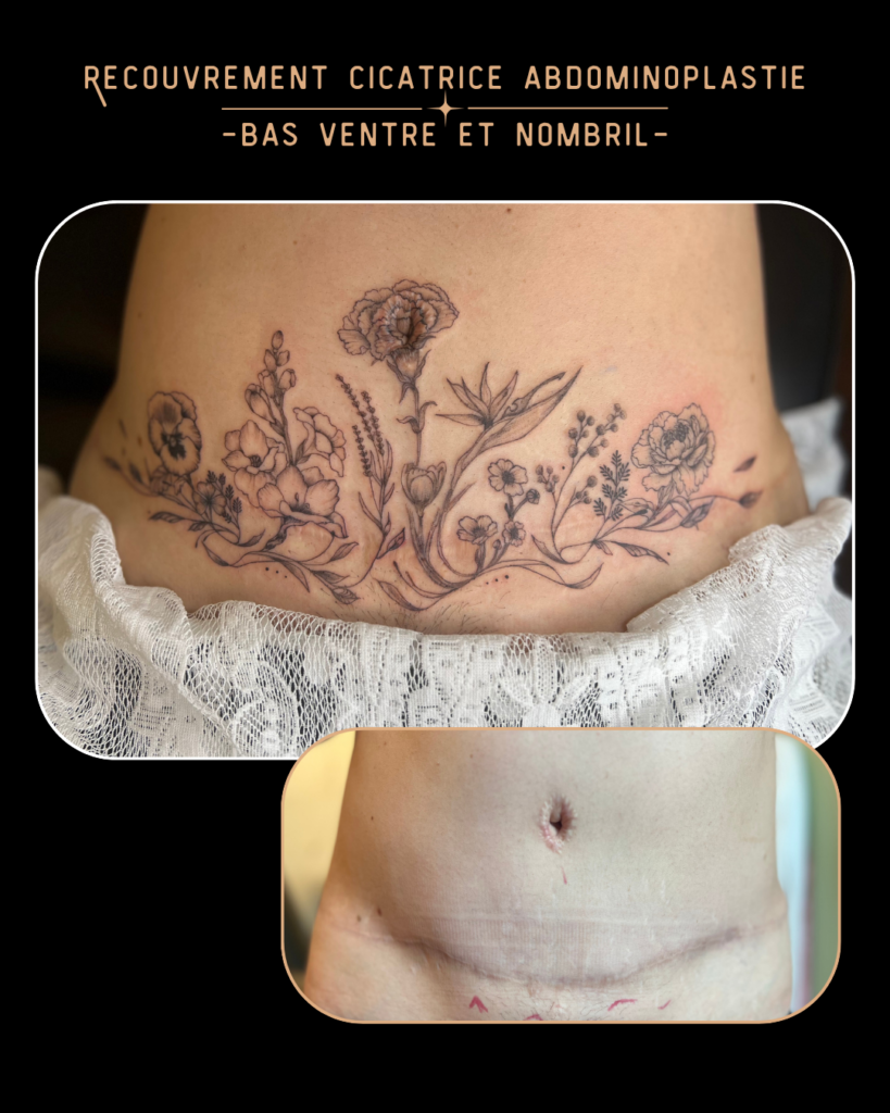 Cover cicatrice abdominale Magalie